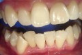 Zęby pacjenta po wybielaniu metodą ZOOM-2