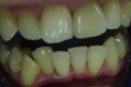 Zęby pacjenta przed wybielaniem metodą ZOOM-2